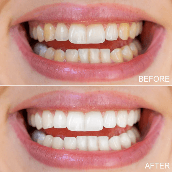 Invisalign result 1