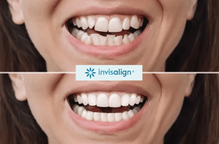 Invisalign result 4